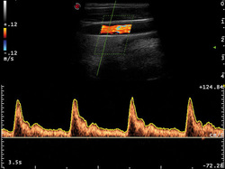 pulzni dopplerjev ultrazvok